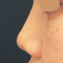 【女性・鼻】SBCプレミアムソフトプロテーゼ_1week