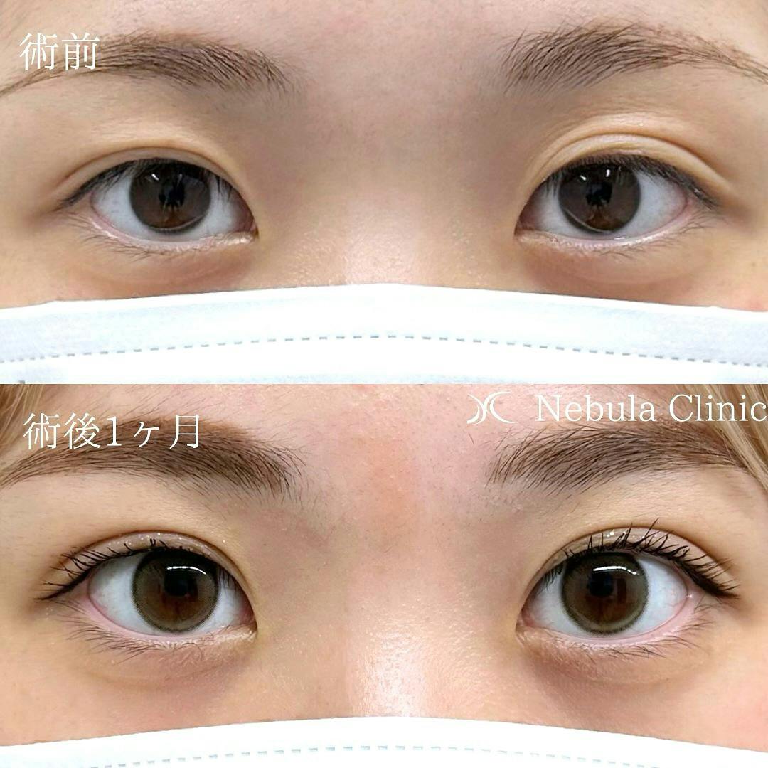 【女性・目元】二重埋没法_before_aftar