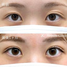 【女性・目元】二重埋没法_before_aftar