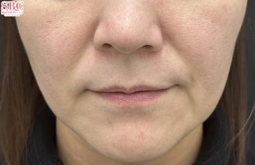 【30代女性・たるみ】ヒアルロン酸ジュビダームビスタ バイクロスシリーズ・VOV（ボブ）リフト・シークレットリフト_before