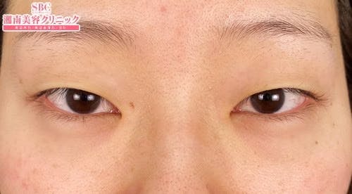 【女性・目元】線留めクロス二重術_before