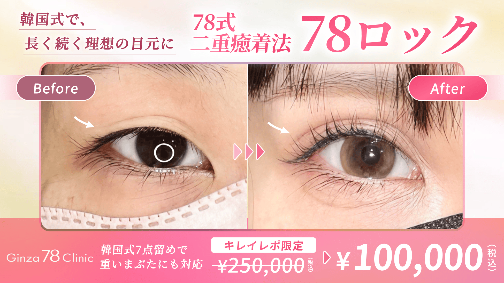 二重自然癒着法 | 韓国式7点留め二重埋没法