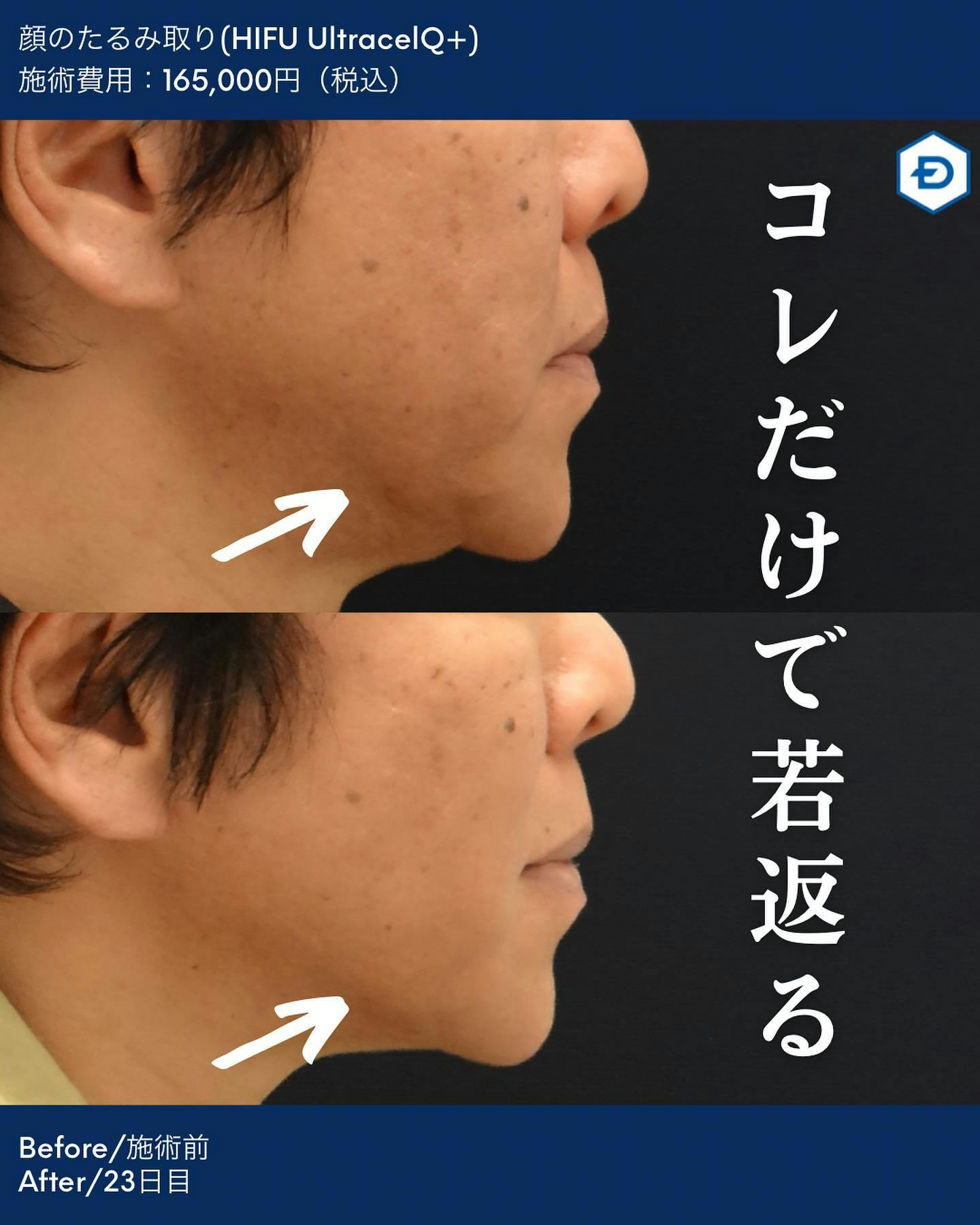 【男性・眉】顔のたるみ取り(HIFU UltracelQ+)_before_aftar