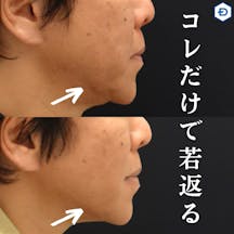 【男性・眉】顔のたるみ取り(HIFU UltracelQ+)_before_aftar