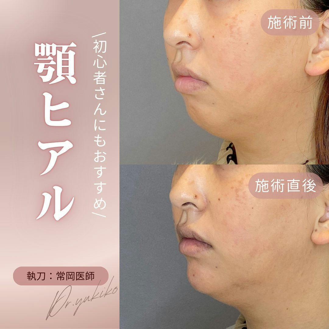 【女性・顎】ヒアルロン酸注入_before_aftar