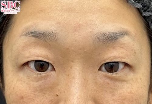 【30代女性・目元】タルミ取り併用全切開法二重・眼瞼下垂_before