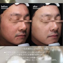 【男性・赤み】コラージュリペア_before_aftar