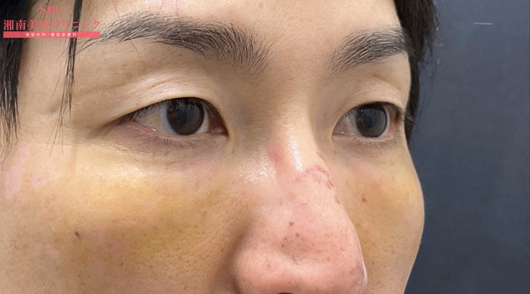 【40代男性・目元】目の下の切らないクマ・たるみ（ふくらみ）取り ナチュラル脂肪注射コンデンスリッチ ナチュラル脂肪注射ナノリッチ_1week