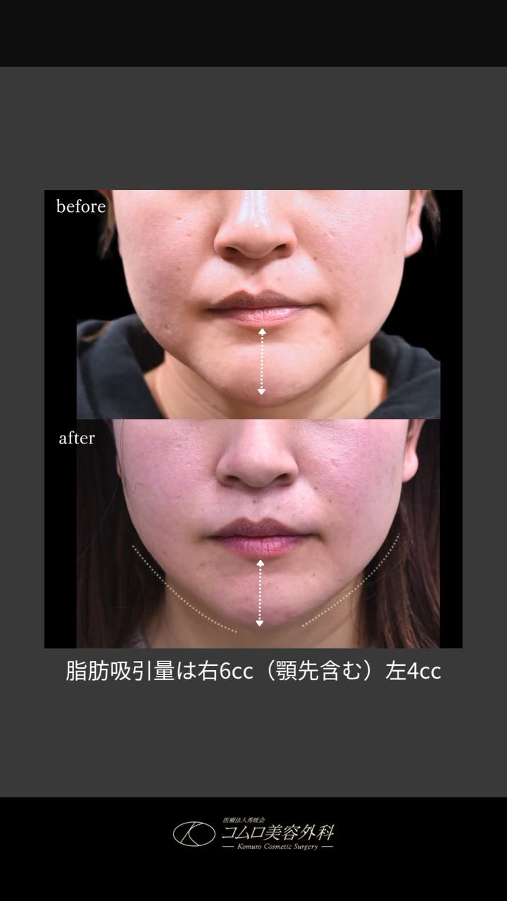 【30代女性・輪郭】顎骨切り・顎下脂肪吸引_before_aftar