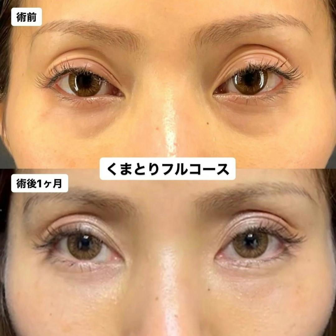 【女性・目元】くまとりフルコース_before_aftar