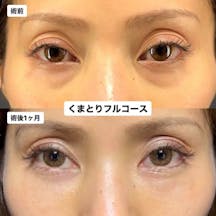 【女性・目元】くまとりフルコース_before_aftar