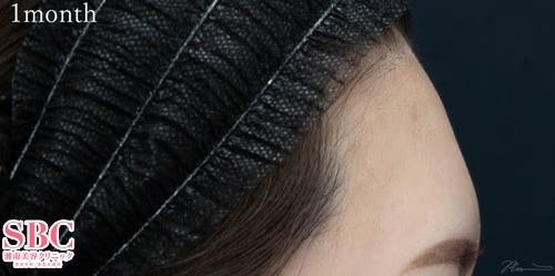 【30代女性・額】SBCプレミアムPRP皮膚再生療法_after