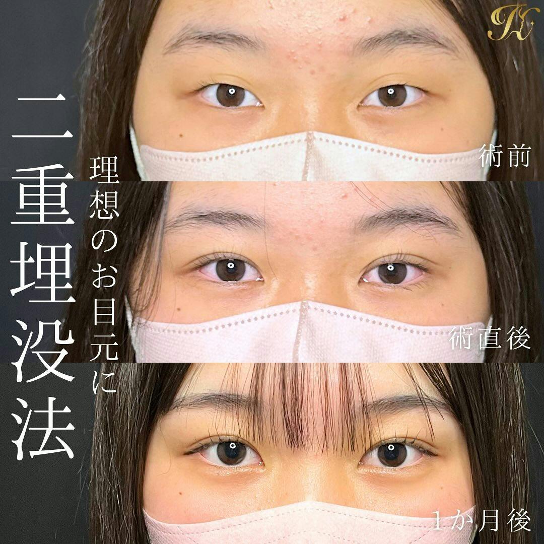 【女性・目元】HBC式二重埋没法_before_aftar