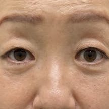 【50代女性・目元】ナチュラル脂肪注射コンデンスリッチ 目の下の切らないクマ・たるみ(ふくらみ)取り コンデンスリッチフェイス脂肪注入全顔入れ放題_after