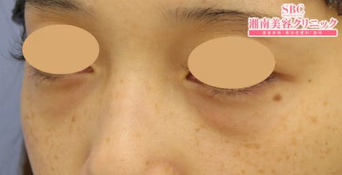 【女性・目元】目の下の切らないクマ・たるみ（ふくらみ）取り、ナチュラル脂肪注射コンデンスリッチ_before