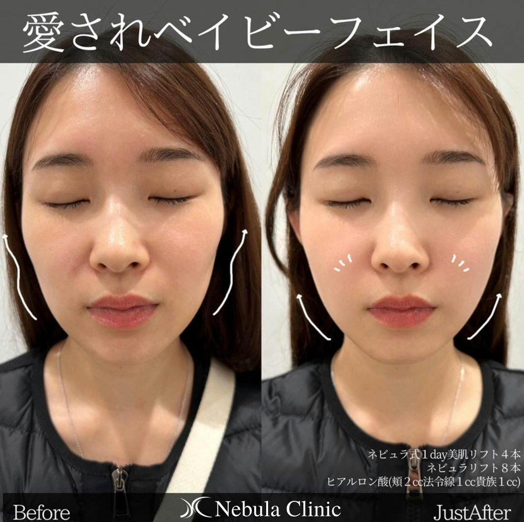 【女性・顔】ネビュラリフト、ネビュラ式 1day 美肌リフト、ヒアルロン酸(頬・法令線・貴族)_before_aftar