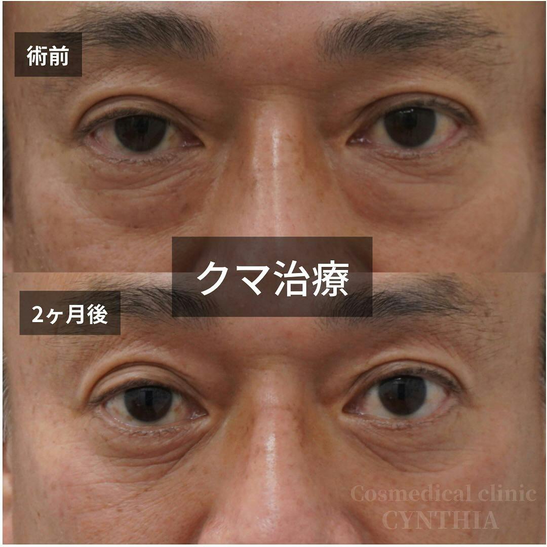 【50代男性・目元】目の下のクマ・たるみ取り_before_aftar