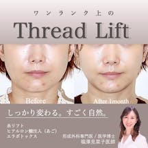 【女性・輪郭】クイックリフト、エラボトックス、ヒアルロン酸(顎)_before_aftar