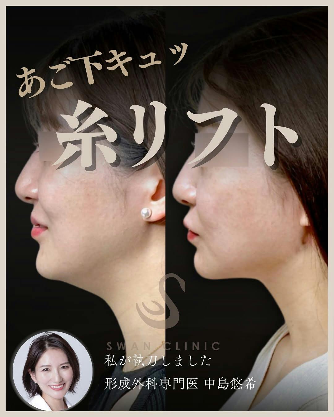 【女性・たるみ】顎下の糸リフト_before_aftar