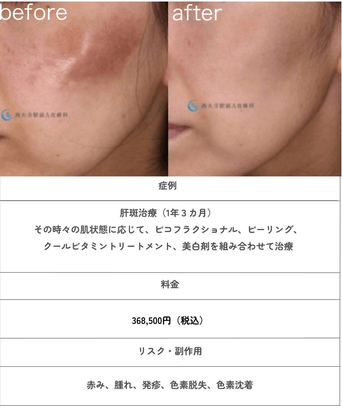 肝斑治療のBEFORE/AFTER画像
