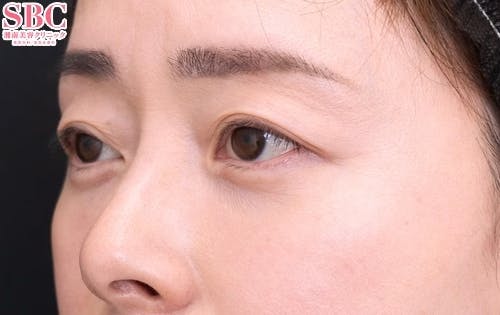 【40代女性・目元】目の下の切らないクマ・たるみ（ふくらみ）取り、ナチュラル脂肪注射コンデンスリッチ_after