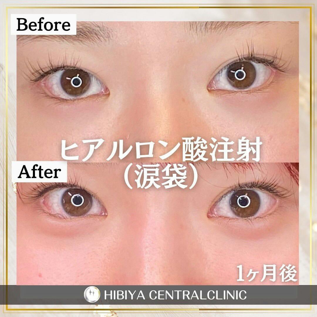 【女性・目元】ヒアルロン酸注射_before_aftar