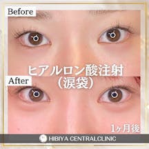 【女性・目元】ヒアルロン酸注射_before_aftar