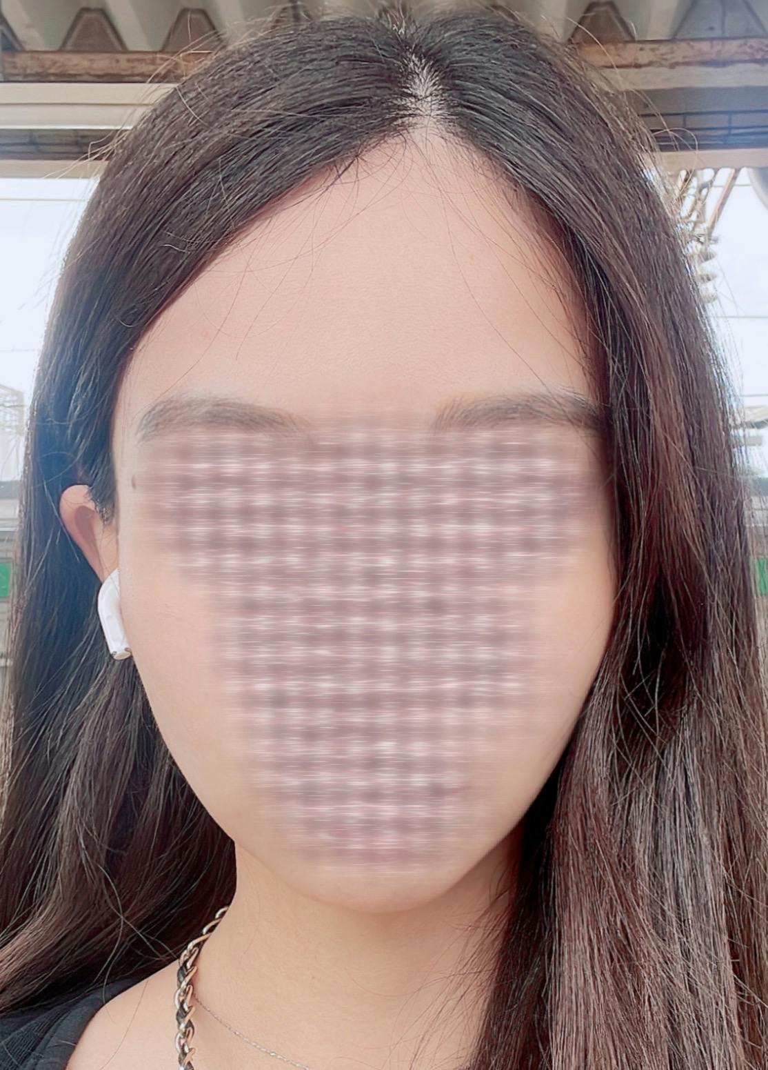 TCB東京中央美容外科 札幌大通院でを受けたmeさんの写真