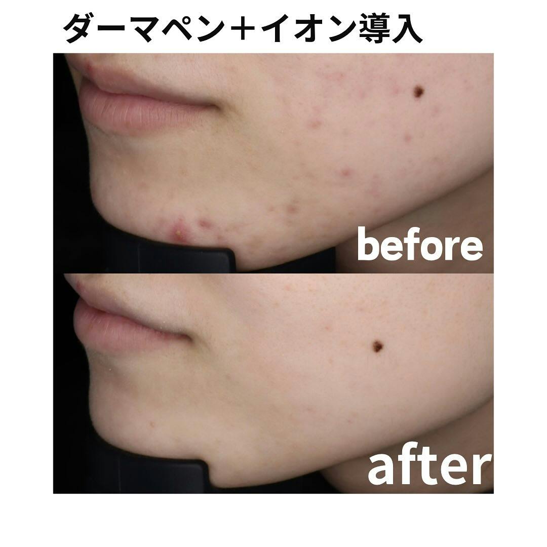 【女性・顔】ダーマペン(ベネブ成長因子あり)＋イオン導入(クールビタミン)_before_aftar