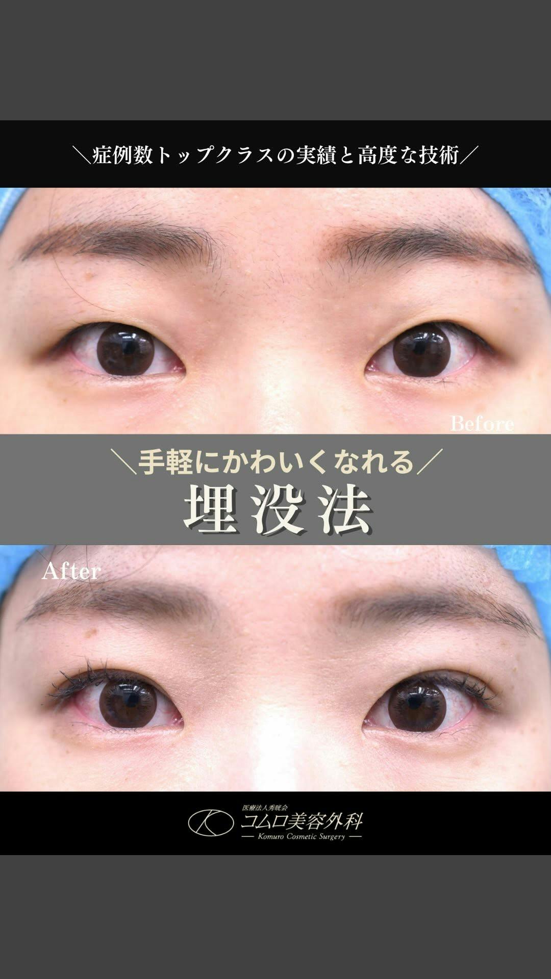 【30代女性・目元】二重埋没法_before_aftar