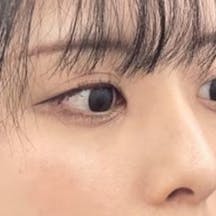 【女性・クマ】目の下の切らないクマ・たるみ(ふくらみ)取り ナチュラル脂肪注射コンデンスリッチ_after