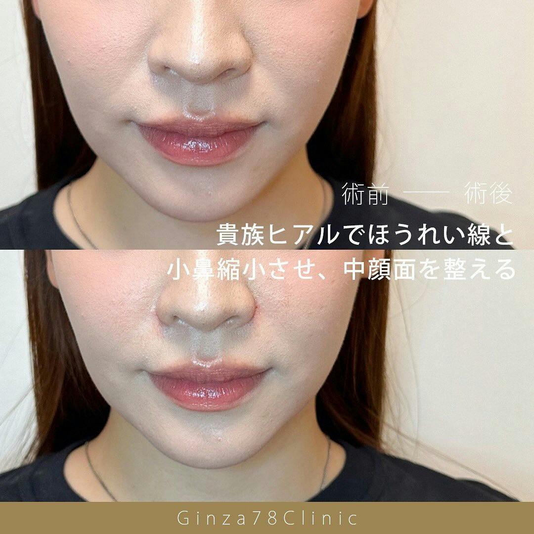 【女性・ほうれい線】ヒアルロン酸注入_before_aftar