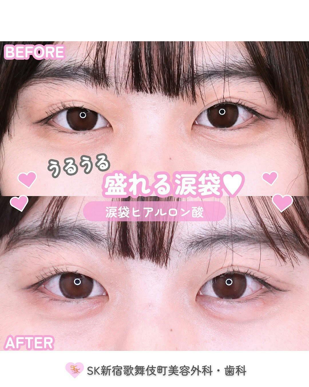 【女性・目元】涙袋ヒアルロン酸_before_aftar