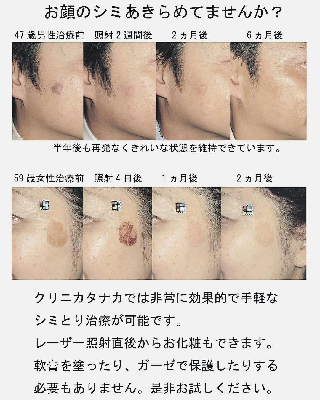 【シミ】シミ取り（レーザー）_before_aftar