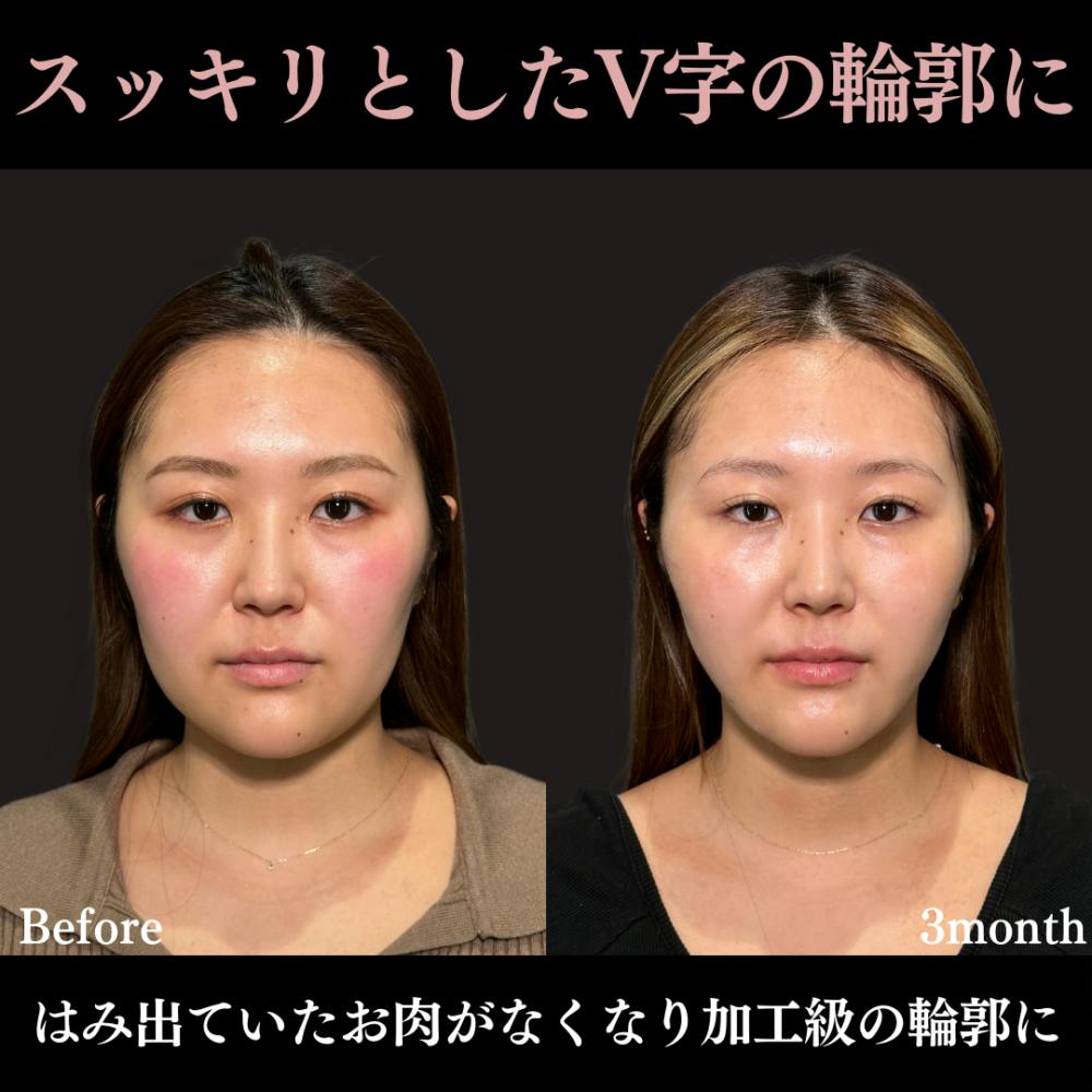 【20代女性・顔】脂肪吸引プレミアム（頬・顎下）＋ グランリフト ＋ ウルトラソフト_before_aftar