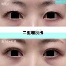 【女性・目元】二重埋没法_before_aftar