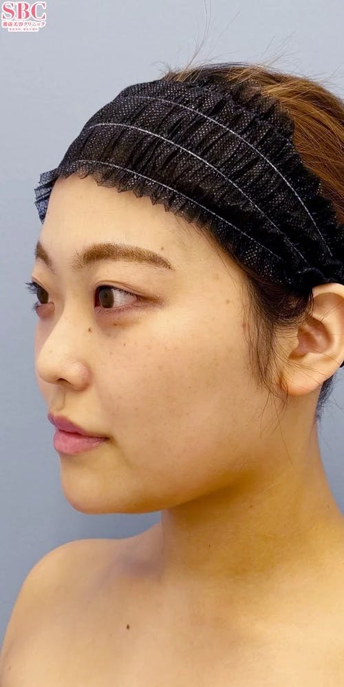 【女性・輪郭】Aquicell（アキーセル）脂肪吸引、根こそぎVASER脂肪吸引_before