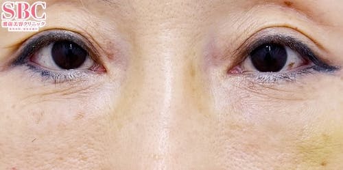 【50代女性・たるみ】目の下の切らないクマ・たるみ（ふくらみ）取り、ナチュラル脂肪注射コンデンスリッチ、ナチュラル脂肪注射ナノリッチ_after