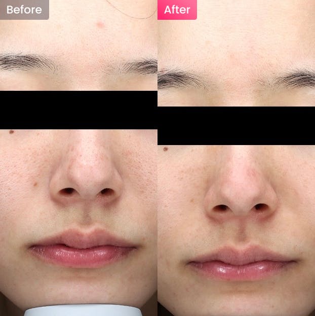 【女性・毛穴】毛穴の開きや赤みを治したい