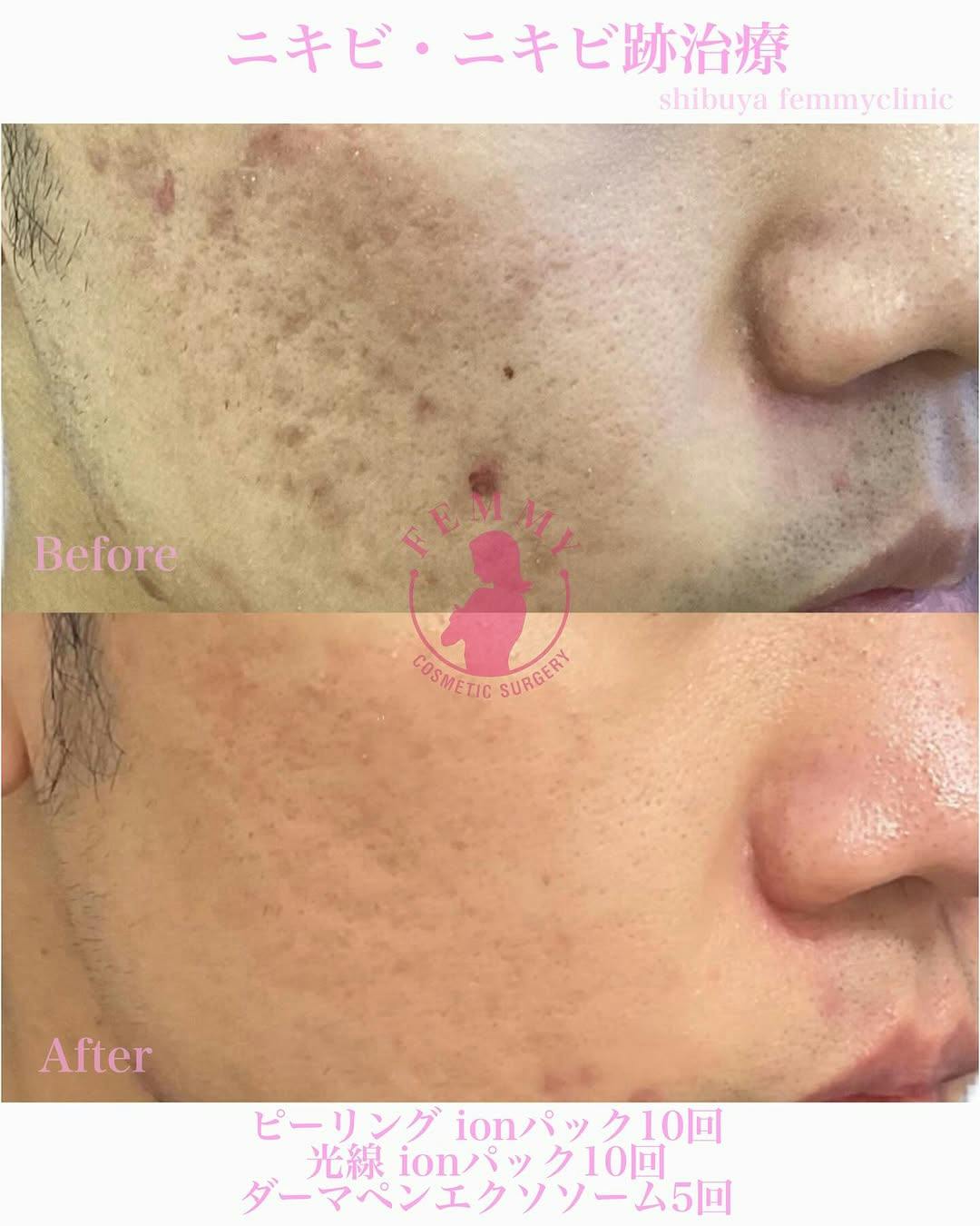 【男性・ニキビ】ケミカルピーリング・光線治療・ダーマペンエクソソーム_before_aftar