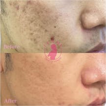 【男性・ニキビ】ケミカルピーリング・光線治療・ダーマペンエクソソーム_before_aftar