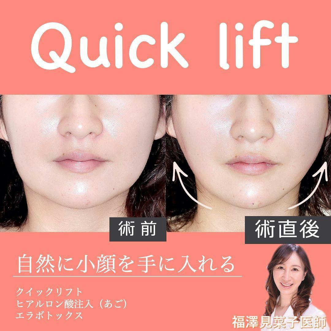 【女性・小顔】クイックリフト、エラボトックス、ヒアルロン酸（顎）_before_aftar