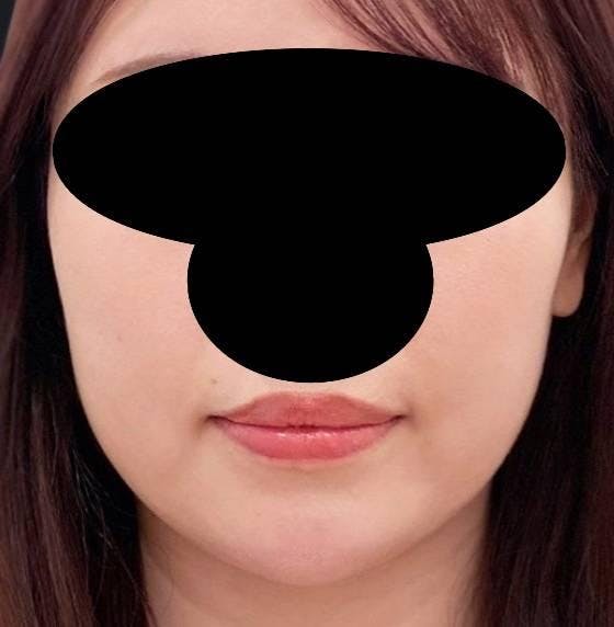 聖心美容クリニック 六本木院で小顔に整形：ボツリヌストキシン注入（注射）を受けたさかもとさんの写真
