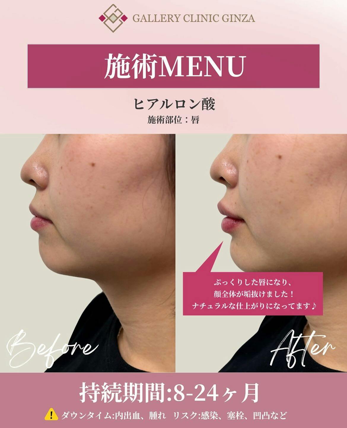 【女性・唇】ヒアルロン酸(唇)_before_aftar