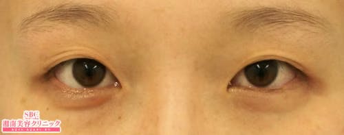 【20代女性・目元】クイックコスメティーク・ダブルNeo_before