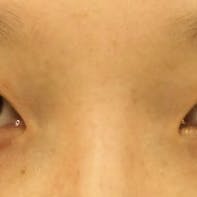 【20代女性・目元】クイックコスメティーク・ダブルNeo_before