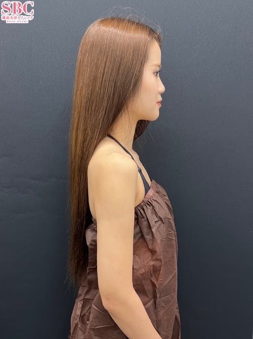 【女性・二の腕】Aquicell（アキーセル）脂肪吸引_aftar