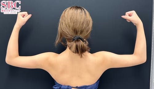 【女性・二の腕】Aquicell(アキーセル)脂肪吸引・エンブレイスRF・根こそぎVASER脂肪吸引_before