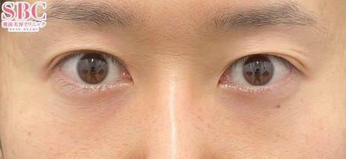 【30代男性・クマ】目の下の切らないクマ・たるみ（ふくらみ）取り ナチュラル脂肪注射コンデンスリッチ ナチュラル脂肪注射ナノリッチ_after