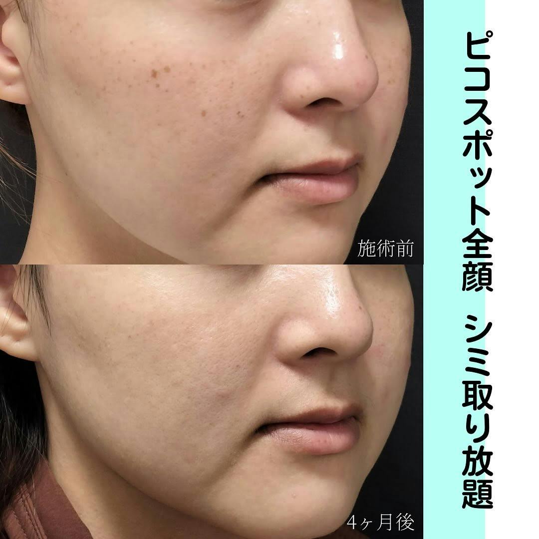 【女性・シミ】ピコスポット全顔_before_aftar